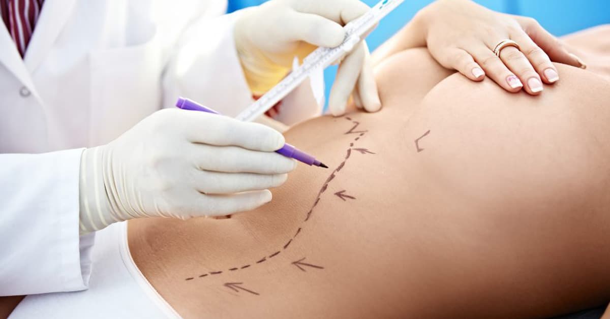 Am I A Good Candidate For A Tummy Tuck?