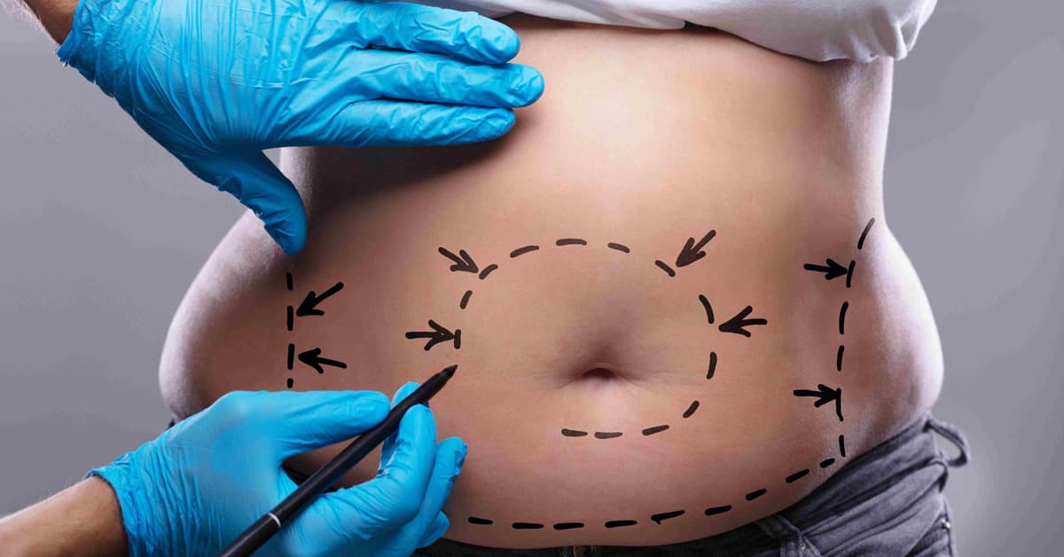 Are tummy tuck surgery permanent