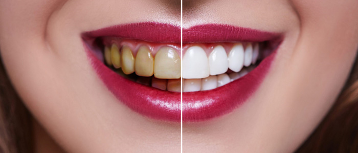 Best alternatives to dental veneers for teeth