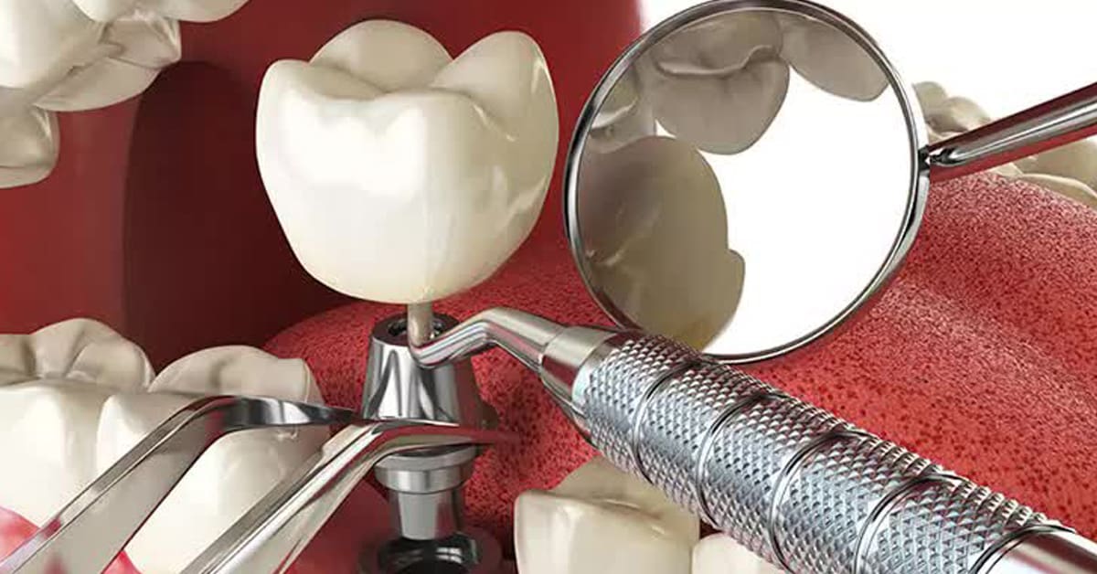 Best dental implant brands