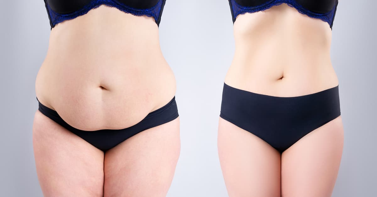 best tummy tuck surgeons in turkey