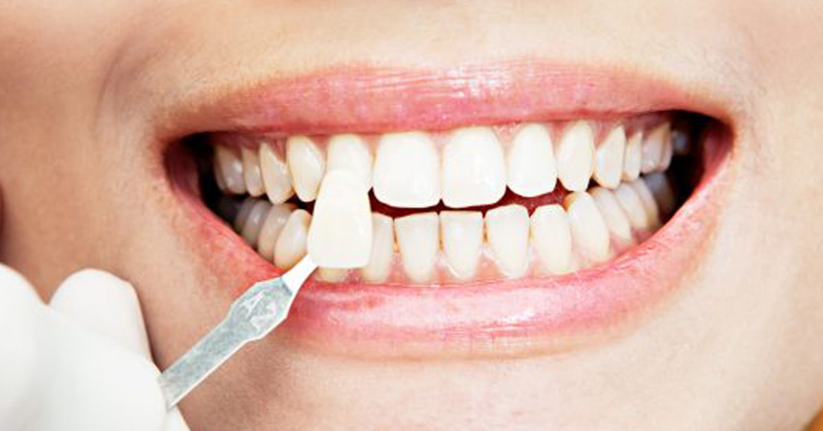 Dental veneers aftercare tips