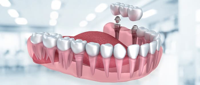 do dental implants look fake