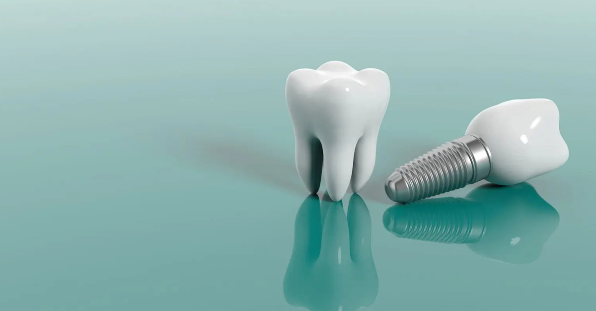 Does dental insurance cover implants