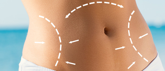 How is tummy tuck surgery performed