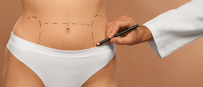 is a tummy tuck permanent