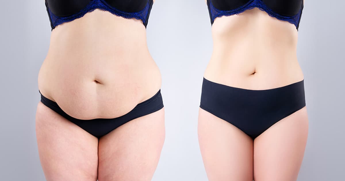 is tummy tuck surgery painfull