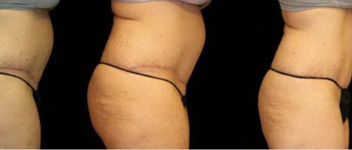 What does a tummy tuck scar look like?