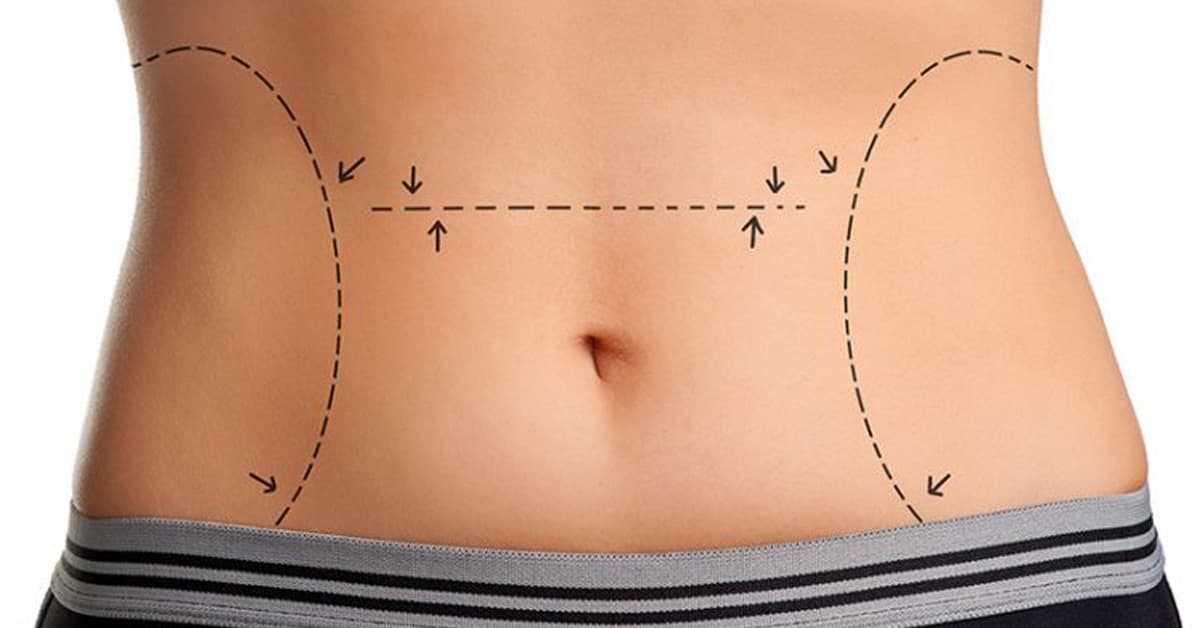 What is tummy tuck surgery