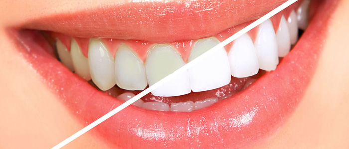 Why dental veneers cheap in turkey