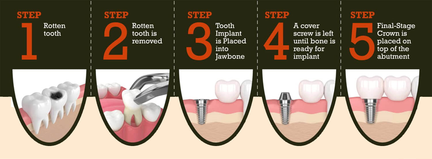 Dental Implant Prices