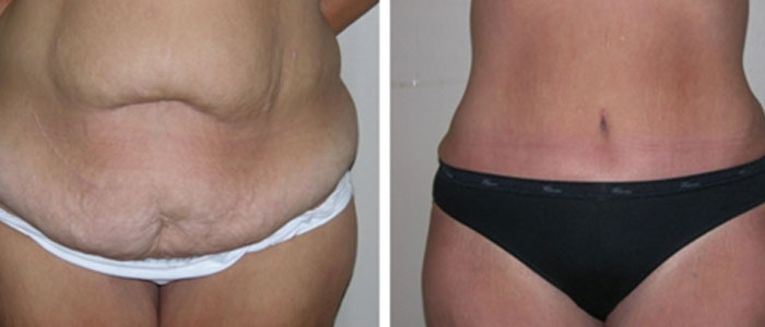 body lift surgery before after