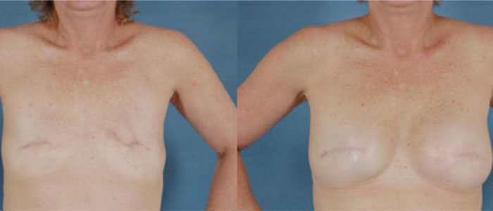 Breast reconstruction surgery after cancer